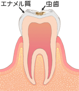 虫歯治療　c1