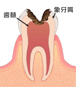 虫歯治療　c3